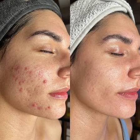 ژل ضدجوش دیفرین