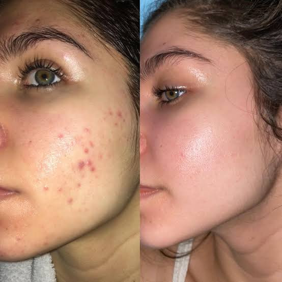 ژل ضدجوش دیفرین